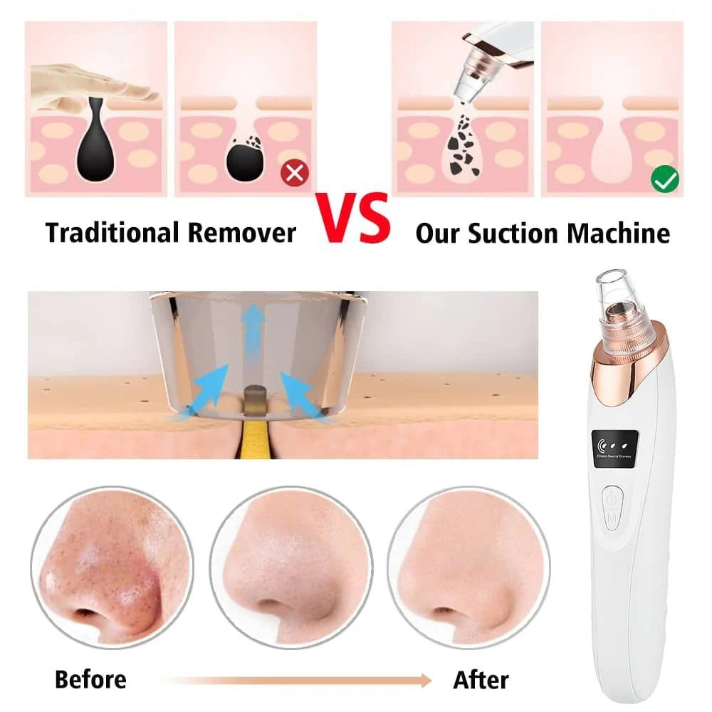 Digital Blackhead Remover Vacuum | Electric Pore Cleaner & Facial Acne Removal Tool